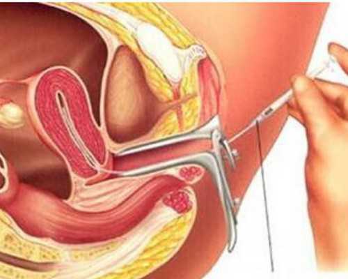 无锡供精试管婴儿要多久,无锡大学第一附属医院供卵等多久呢